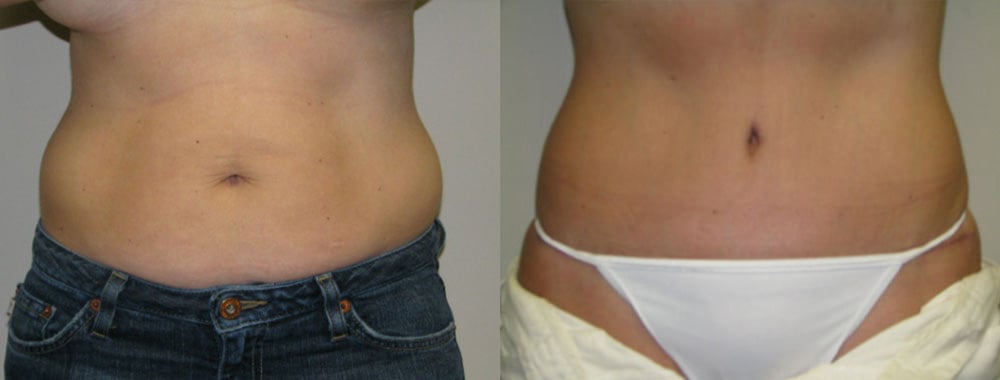 Abdominoplasty before and after photo by Michael J. Lee M.D. in Chicago, IL