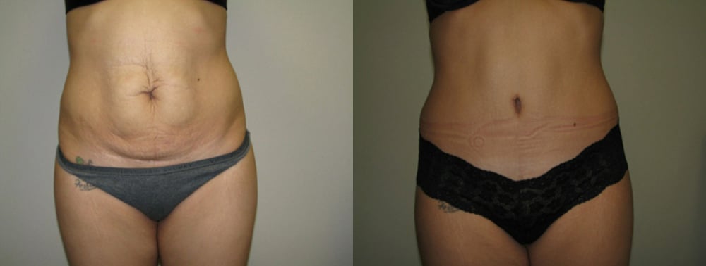 Abdominoplasty before and after photo by Michael J. Lee M.D. in Chicago, IL