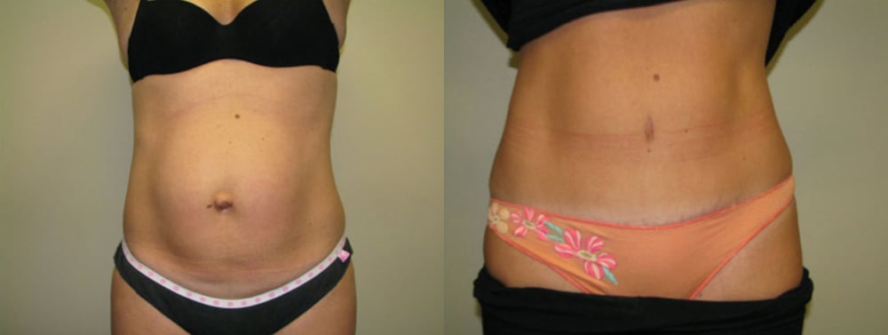 Abdominoplasty before and after photo by Michael J. Lee M.D. in Chicago, IL