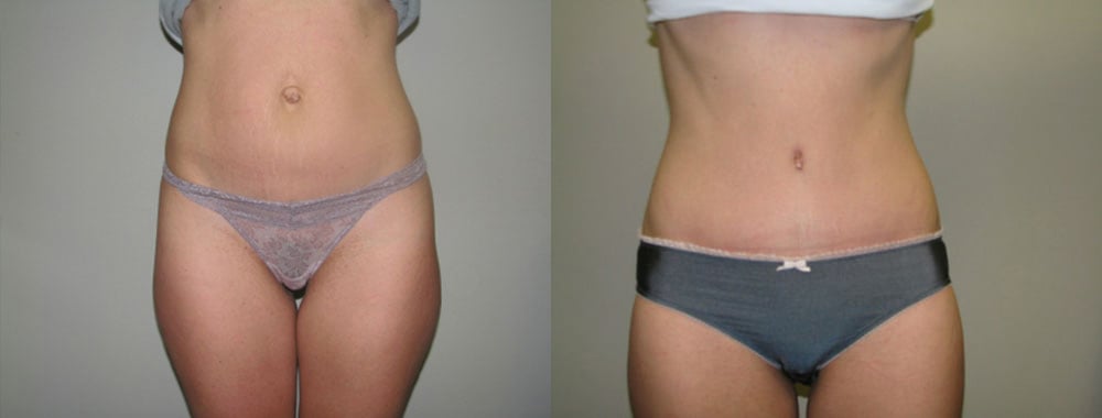 Abdominoplasty before and after photo by Michael J. Lee M.D. in Chicago, IL