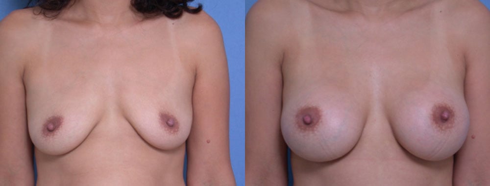 Breast Augmentation before and after photo by Michael J. Lee M.D. in Chicago, IL