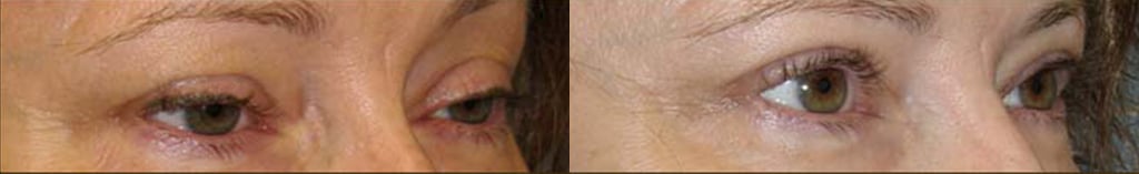 Eyelid Surgery before and after photo by Michael J. Lee M.D. in Chicago, IL