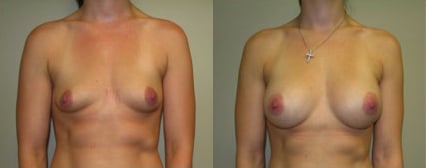 Breast Augmentation before and after photo by Michael J. Lee M.D. in Chicago, IL