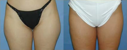 Liposuction before and after photo by Michael J. Lee M.D. in Chicago, IL