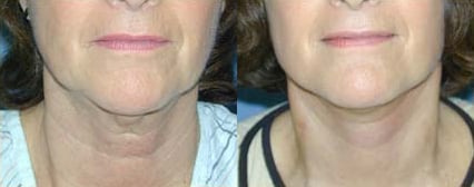 Facelift before and after photo by Michael J. Lee M.D. in Chicago, IL