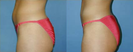 Liposuction before and after photo by Michael J. Lee M.D. in Chicago, IL