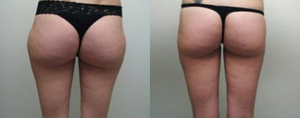 Liposuction before and after photo by Michael J. Lee M.D. in Chicago, IL
