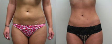 Liposuction before and after photo by Michael J. Lee M.D. in Chicago, IL