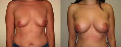 Breast Augmentation before and after photo by Michael J. Lee M.D. in Chicago, IL