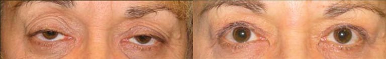 Eyelid Surgery before and after photo by Michael J. Lee M.D. in Chicago, IL Eyelid Surgery before and after photo by Michael J. Lee M.D. in Chicago, IL