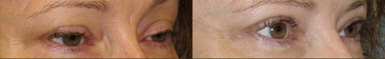 Eyelid Surgery before and after photo by Michael J. Lee M.D. in Chicago, IL Eyelid Surgery before and after photo by Michael J. Lee M.D. in Chicago, IL