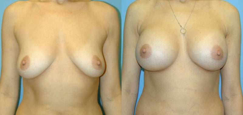 Breast Augmentation before and after photo by Michael J. Lee M.D. in Chicago, IL
