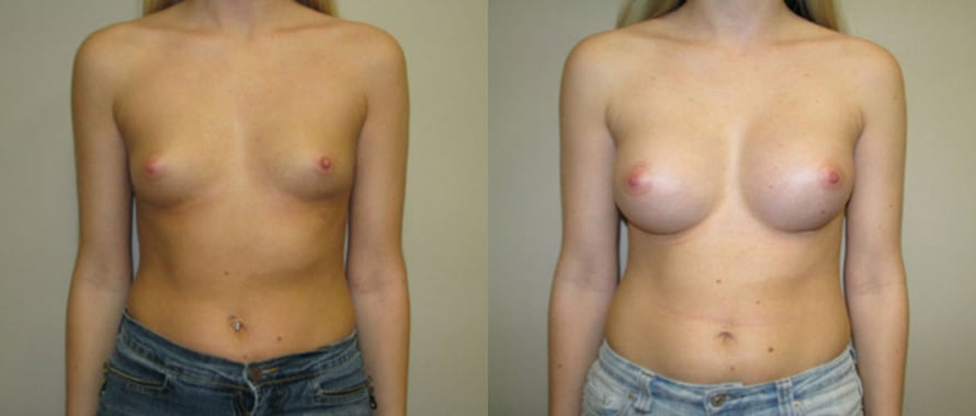 Breast Augmentation before and after photo by Michael J. Lee M.D. in Chicago, IL