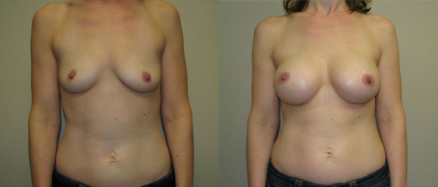 Breast Augmentation before and after photo by Michael J. Lee M.D. in Chicago, IL