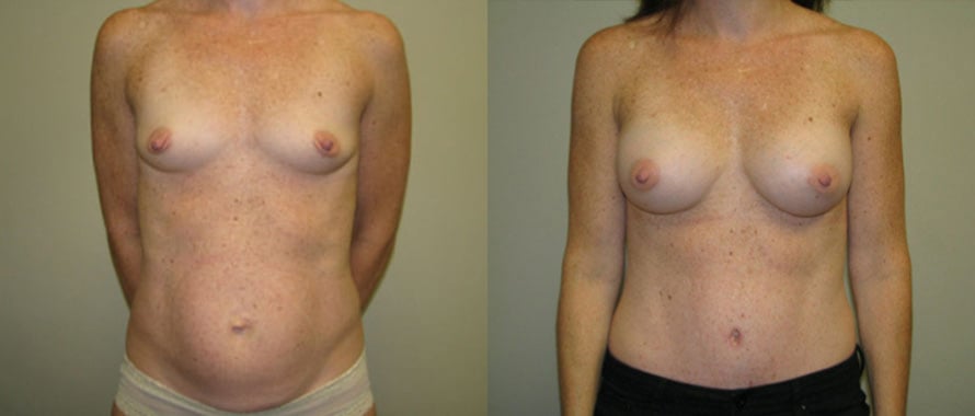 Breast Augmentation before and after photo by Michael J. Lee M.D. in Chicago, IL