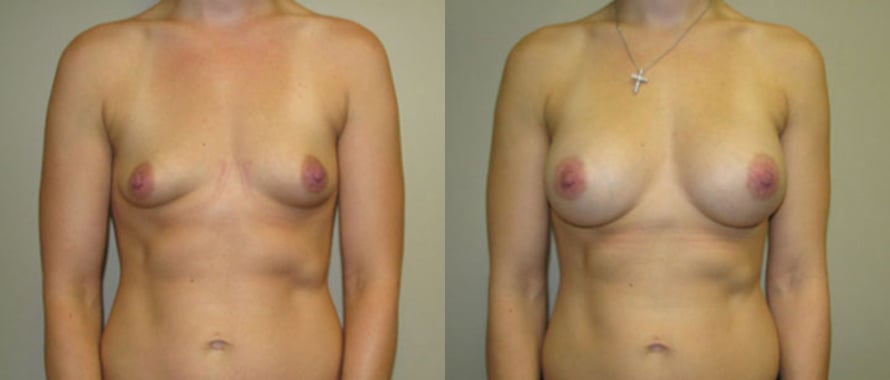 Breast Augmentation before and after photo by Michael J. Lee M.D. in Chicago, IL