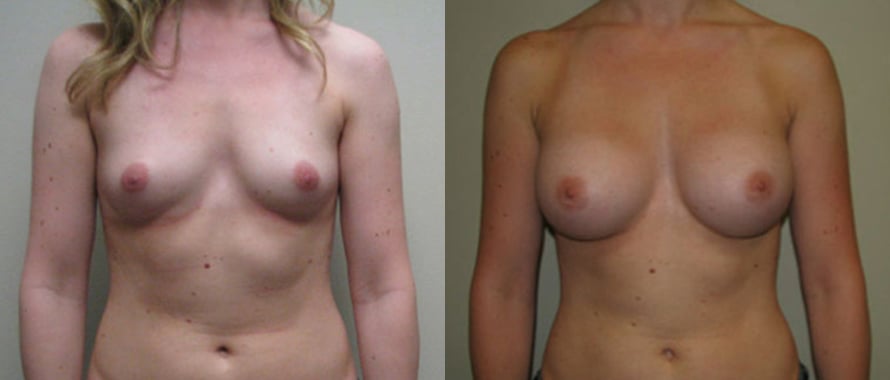 Breast Augmentation before and after photo by Michael J. Lee M.D. in Chicago, IL