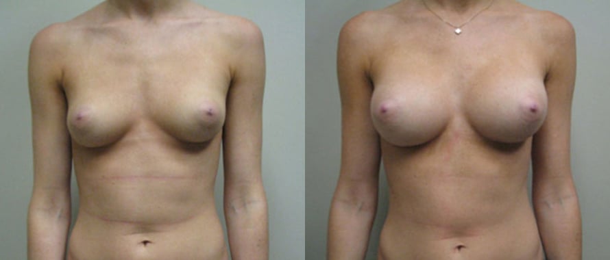 Breast Augmentation before and after photo by Michael J. Lee M.D. in Chicago, IL