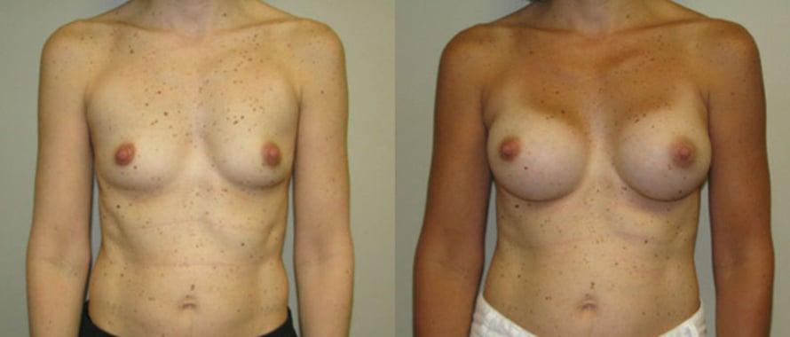 Breast Augmentation before and after photo by Michael J. Lee M.D. in Chicago, IL