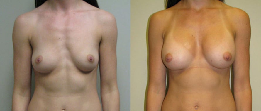 Breast Augmentation before and after photo by Michael J. Lee M.D. in Chicago, IL