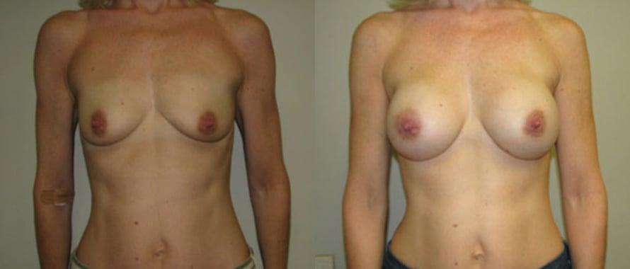 Breast Augmentation before and after photo by Michael J. Lee M.D. in Chicago, IL