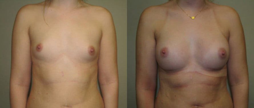 Breast Augmentation before and after photo by Michael J. Lee M.D. in Chicago, IL