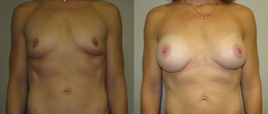 Breast Augmentation before and after photo by Michael J. Lee M.D. in Chicago, IL