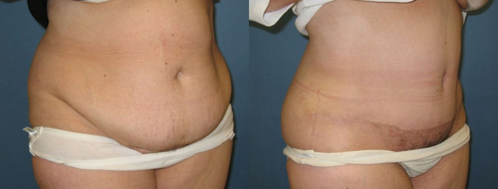 Abdominoplasty before and after photo by Michael J. Lee M.D. in Chicago, IL